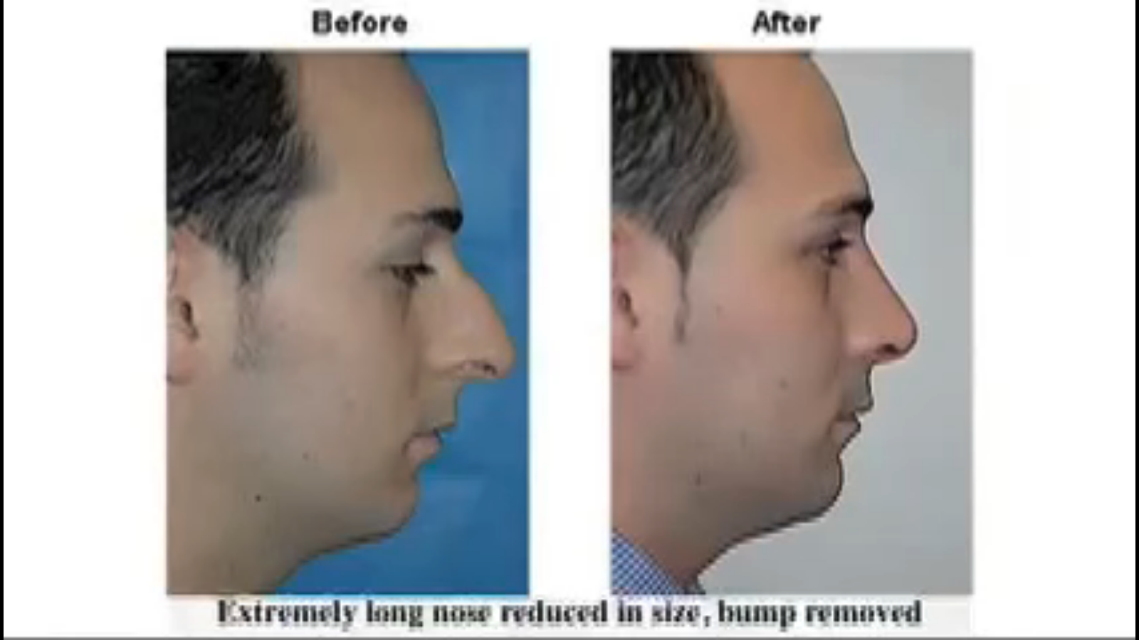 Métodos del procedimiento de rinoplastia