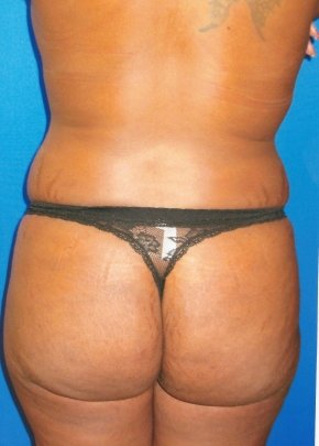 SmartLipo