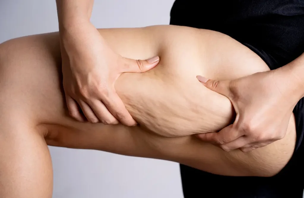 Does Liposuction Get Rid of Cellulite