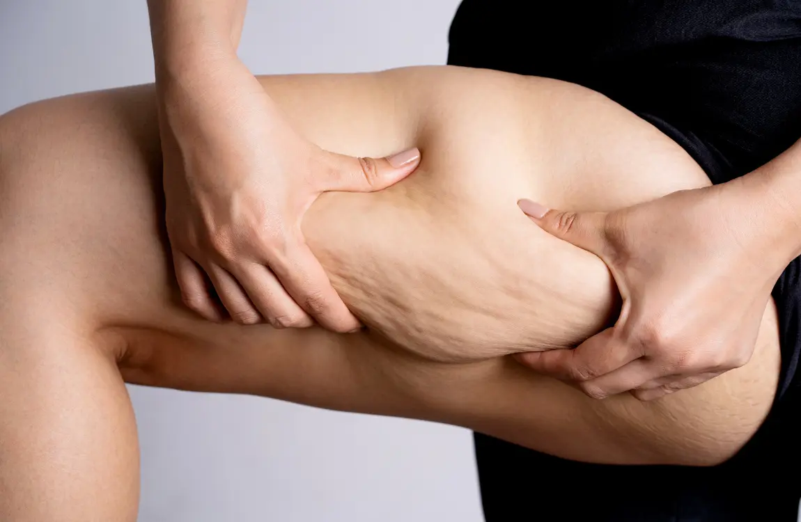 Does Liposuction Get Rid of Cellulite