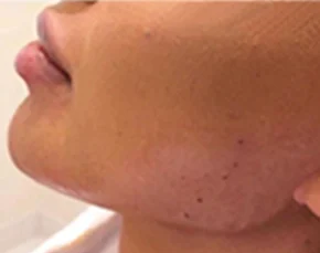 Before and After Jawline Contouring in NYC