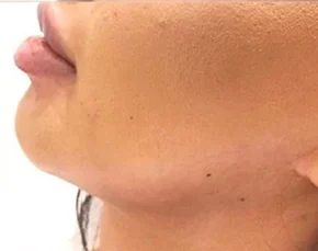 Before and After Jawline Contouring in NYC