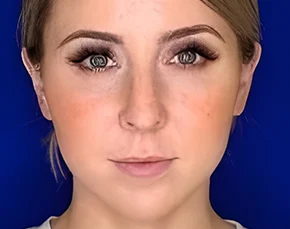 Before and After Buccal Fat Removal in NYC