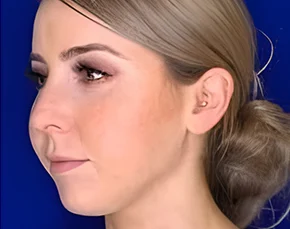 Before and After Buccal Fat Removal in NYC