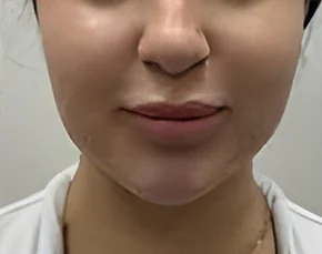 Before and After Chin Liposuction in NYC