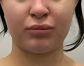 Before and After Chin Liposuction in NYC