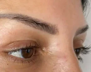 Before and After Fox Eyelift in NYC