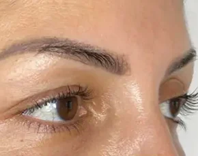 Before and After Fox Eyelift in NYC