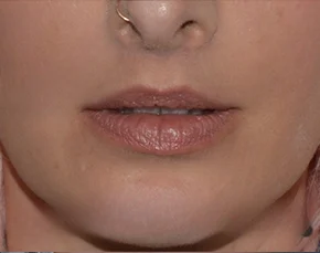 Before and After Lip Lift in NYC
