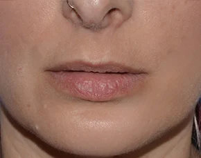 Before and After Lip Lift in NYC
