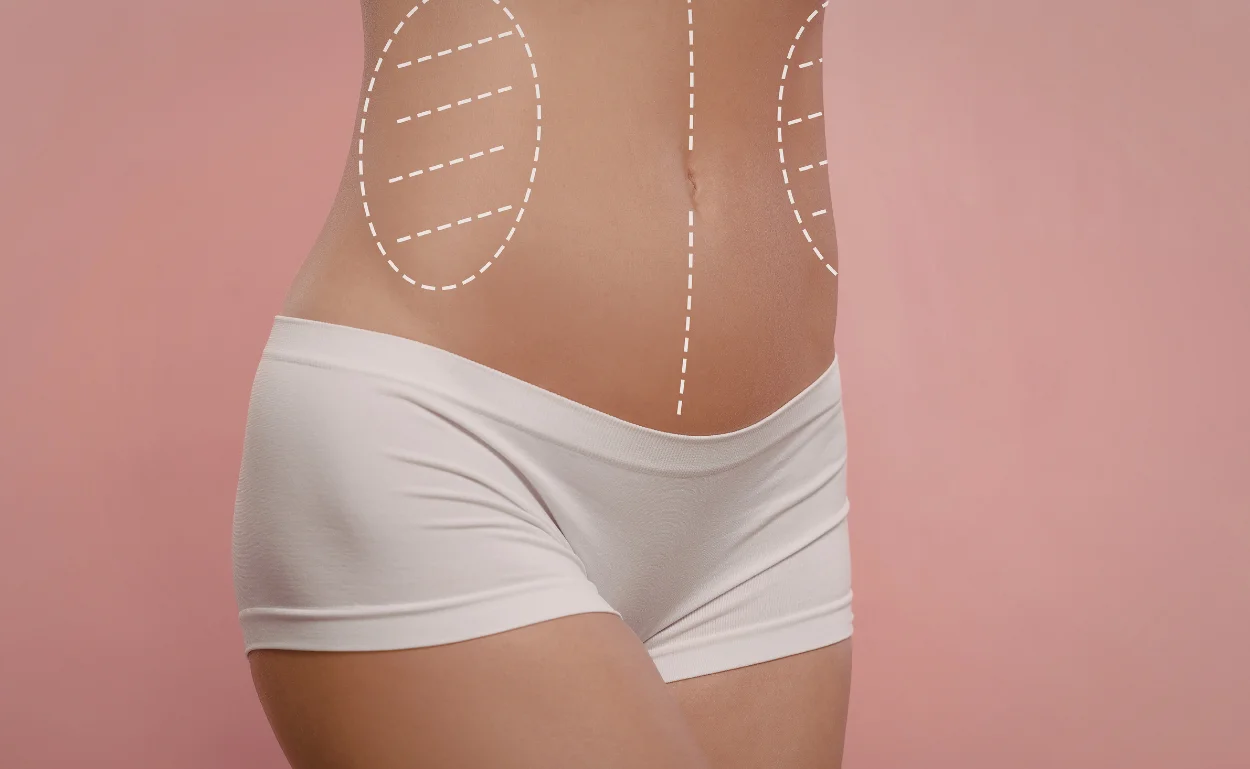 How Long Does It Take to Recover from Liposuction?